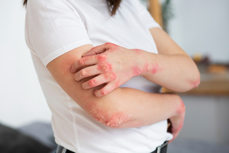 Psoriasis problemas estomacales