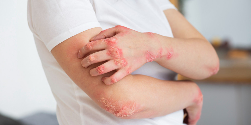 La respuesta a los problemas estomacales en personas con psoriasis