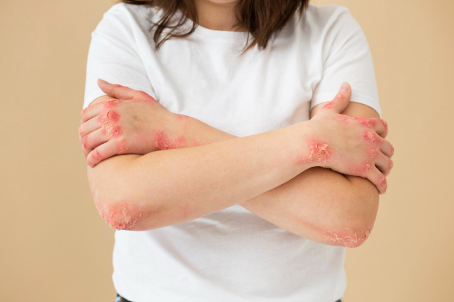 Psoriasis y ultraprocesados