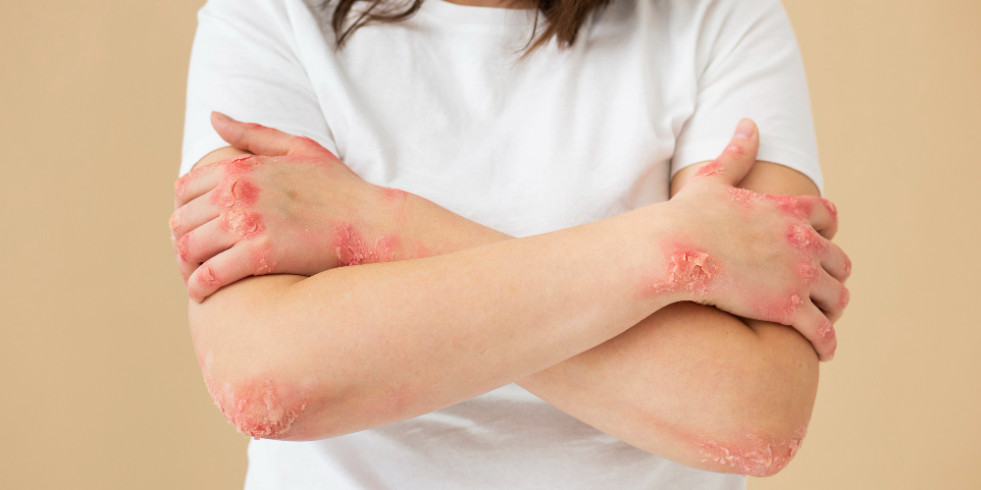 Controlar el consumo de ultraprocesados disminuye el riesgo de desarrollar psoriasis