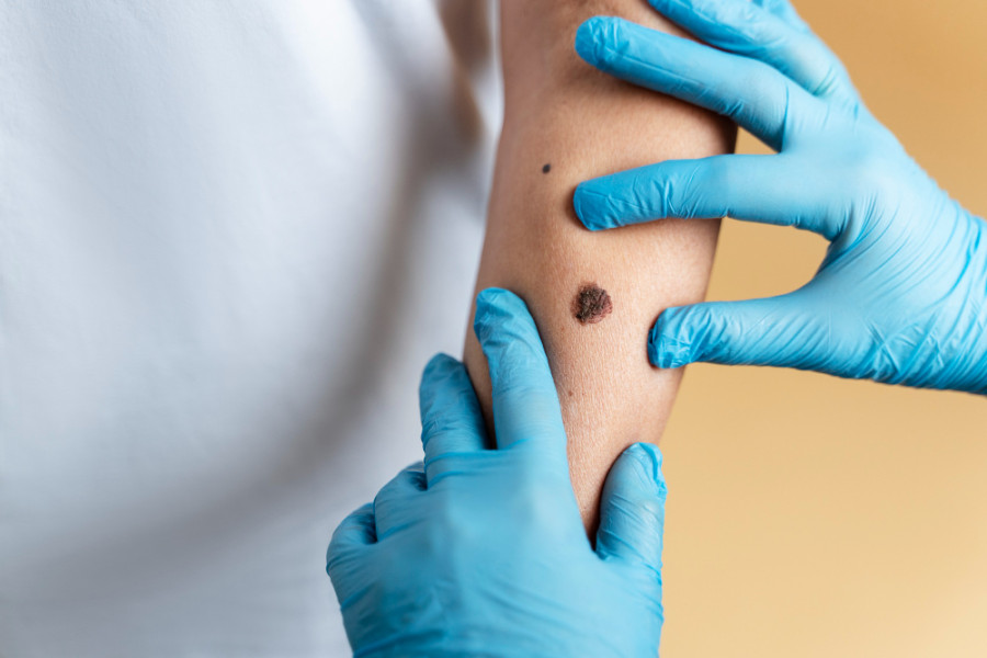 Melanoma